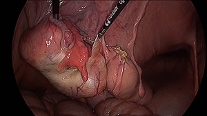 Laparoscopic Ovariectomy